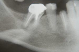 Two hopeless teeth molar and premolar