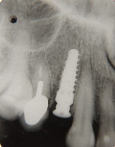 How long do implant last? premolar