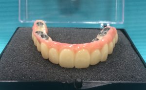 zirconia hybrid bridge