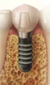 single missing tooth replaced with dental implant