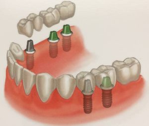 replacing two or more teeth with implants