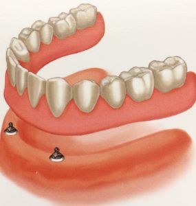 overdenture two implants